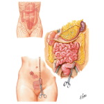 Ileostomy and Subtotal Colectomy