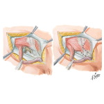 Hernia I - Indirect and Direct Inguinal Hernias