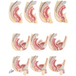 Imperforate Anus