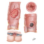 Malignant Tumors of Large Intestine