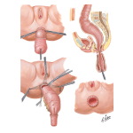 Congenital Intestinal Obstruction VI - Megacolon (Hirschsprung's Disease)