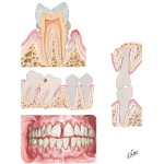 Periodontal Disease