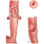 Malignant Tumors II - Midportion of Esophagus