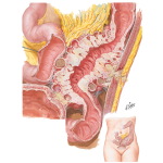 Diverticulitis (Peridiverticular Fibrosis)