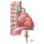 Displacement of Esophagus