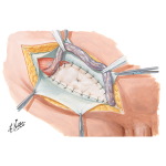 Repair of Recurrent Hernia With Plastic Patch