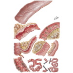 Enterogenous Malabsorption Syndrome (Sprue Syndrome)