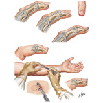 Loss of Soft Tissue Only