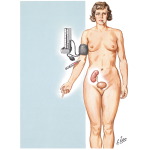 Kidney Transplantation