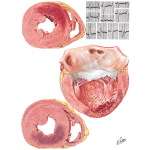 Arteriosclerotic Heart Disease