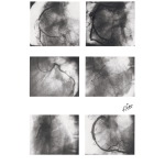 Surgery for Coronary Artery Disease - Arteriograms