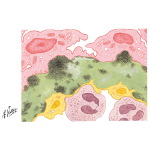 Kidney Transplantation