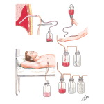 Autotransfusion of Pleural Blood Under-Water-Seal Drainage