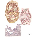 Pathology of Rheumatoid Arthritis