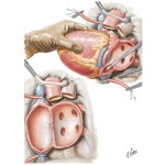 Heart Transplantation - Recipient Preparation