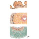Occlusive Disease of Main Renal Artery