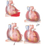 Penetrating Heart Wounds