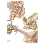 Trauma to the Bladder