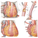 Segmental Replacement of Right Coronary Artery-Bypass of Right Coronary Artery