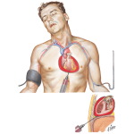 Penetrating Heart Wounds
