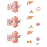Renovascular Hypertension