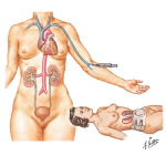 Intravenous Pyelography (Excretory Urography)