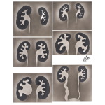 Exemplary Abnormalities Which May Appear On the Intravenous Pyelogram (IVP)