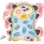 Acute Glomerulonephritis