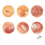 Tumors of the Bladder