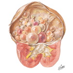 Echinococcus Disease of the Kidney