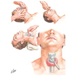 Upper Airway Obstruction
