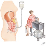 Peritoneal Dialysis
