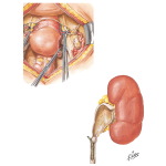 Injuries to the Ureter