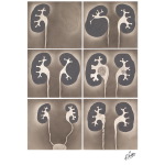 Exemplary Abnormalities Which May Appear On the Intravenous Pyelogram (IVP)