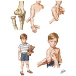 Dislocation and Subluxation of the Radius
