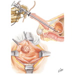Tumors of the Bladder
