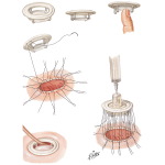 Free-Floating Discoid Valve for Mitral and Tricuspid Replacement