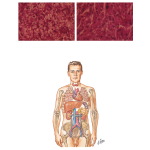 Malignant Tumors of the Kidney