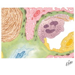 Kidney Transplantation