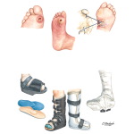 Diagnosis and Treatment of Ulcer Infections
