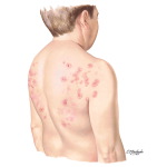 Dermatitis herpetiformis