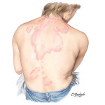 Tinea Corporis