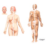 Vitiligo