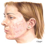 Acne Vulgaris