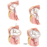 Chordal Transfer, Sliding Annuloplasty, and Ring Annuloplasty