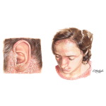 Sebhorrheic Dermatitis