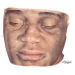 Pityriasis Alba