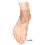 Neurodermatitis Pictures