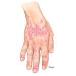 Lichen Planus