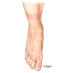 Contact Dermatitis